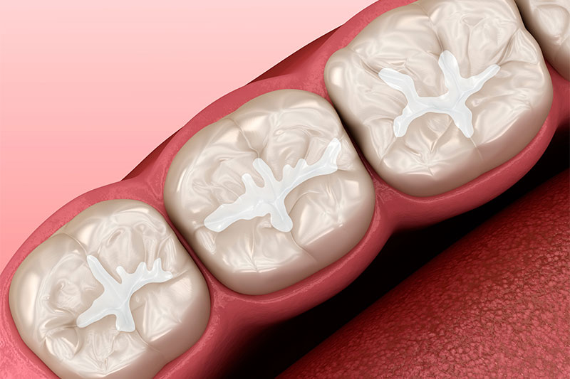 Sealants in Clarkston