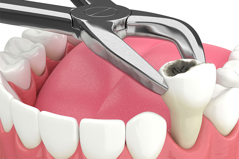 Tooth Extractions in Clarkston