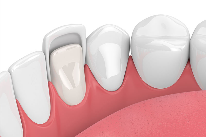 Porcelain Veneers in Clarkston