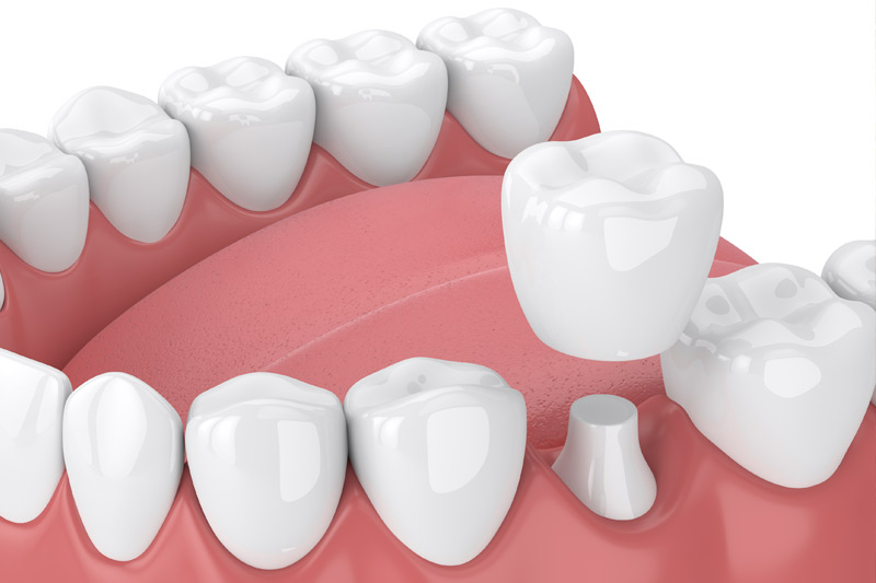 Dental Crowns in Clarkston