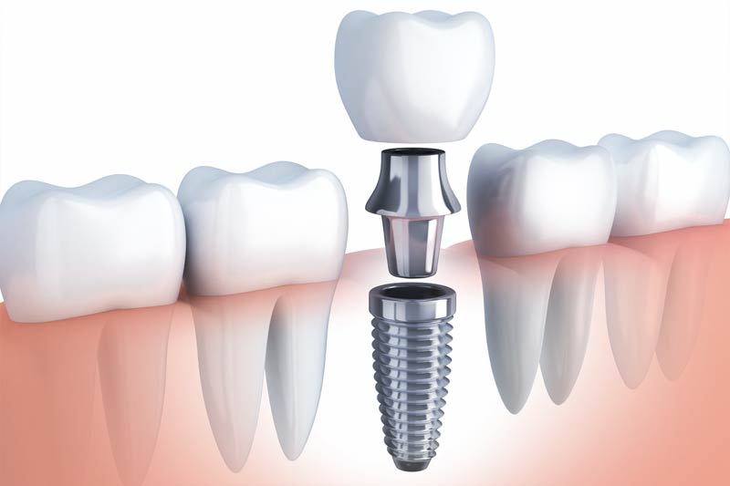 Implants Dentist in Clarkston