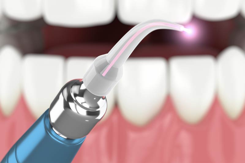 Laser Dentistry in Clarkston