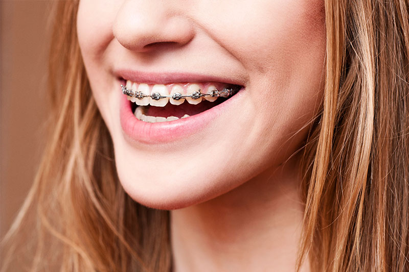 Orthodontic Treatment in Clarkston