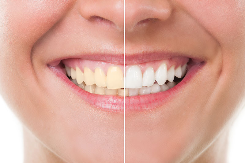 Teeth Whitening in Clarkston
